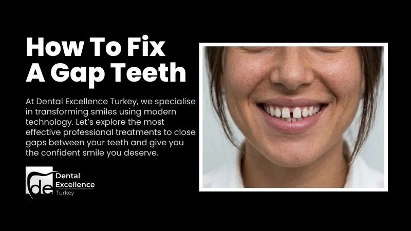 Treatment options for gapped teeth