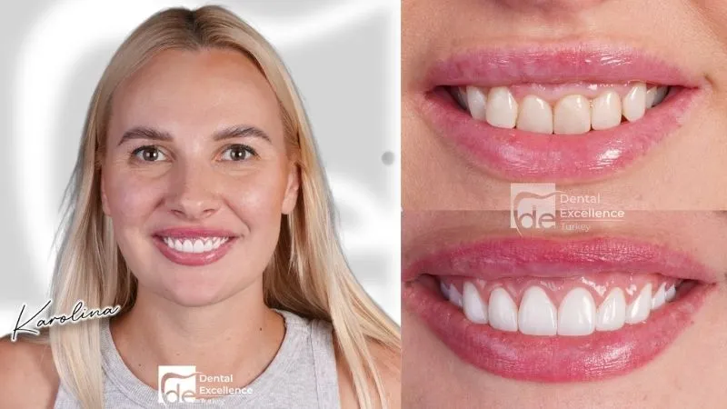 Gum health treatment Dental restoration result
