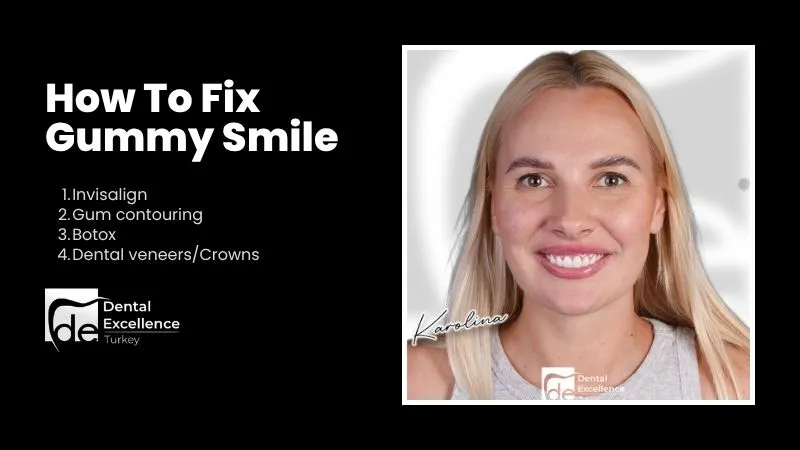 Gummy smile treatment options