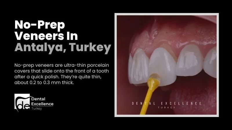 No-preparation porcelain veneers